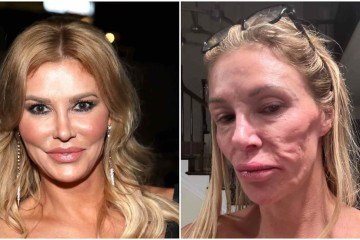 Após retirar os implantes, ela relatou melhora imediata e fez alerta sobre doença do implante mamário - (crédito: Reprodução / Instagram ) Após retirar os implantes, ela relatou melhora imediata e fez alerta sobre doença do implante mamário - (crédito: Reprodução / Instagram )