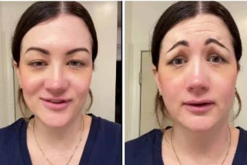 Aplicação de botox com erro deixou mulher com aparência de palhaço triste - (crédito: TikTok / reprodução) Aplicação de botox com erro deixou mulher com aparência de palhaço triste - (crédito: TikTok / reprodução)