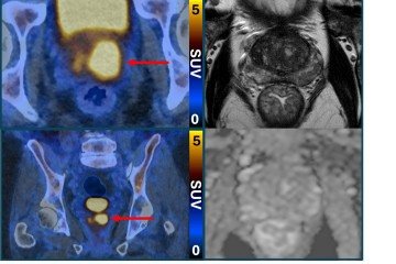 Câncer de próstata clinicamente significativo (esquerda, PET/CT com PSMA) encontrado, apesar da ressonância magnética normal (direita) -  (crédito: Ensaio PRIMARY2)