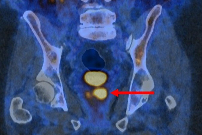 Imagem PET/CT com PSMA mostrando células cancerígenas da próstata brilhantes.

