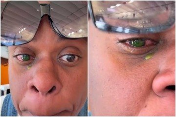 Cacau Protásio mostra desespero após reação alérgica: 'Sem abrir o olho' -  (crédito: Reprodução/Instagram)