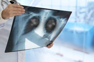 Diagnóstico preventivo pode reduzir o risco de óbito pela doença em até 38%
 -  (crédito: Getty Images)