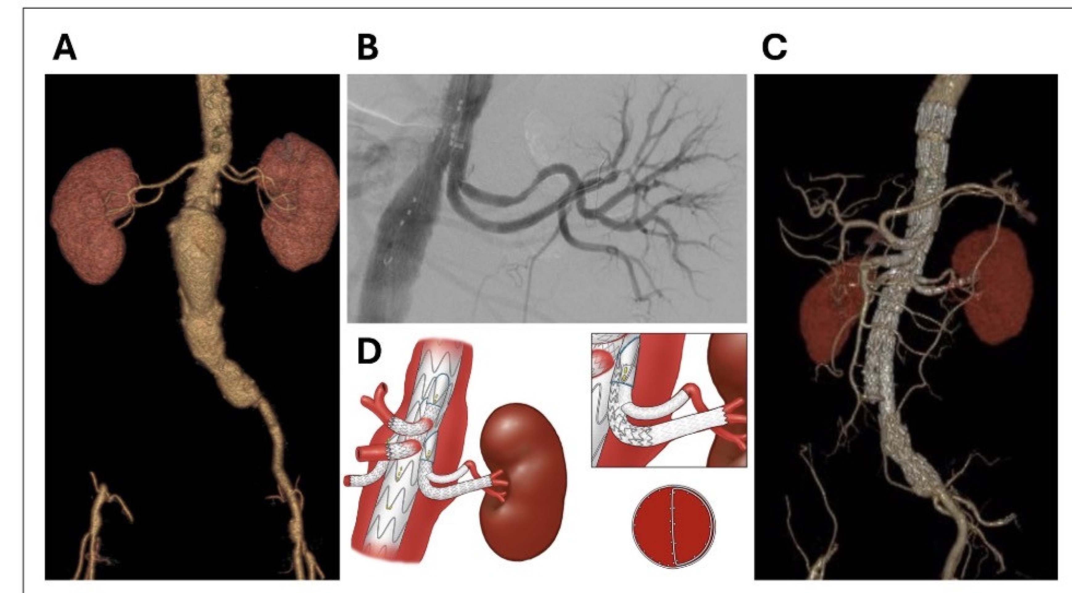 Procedimento aumenta a segurança no tratamento de aneurismas complexos 