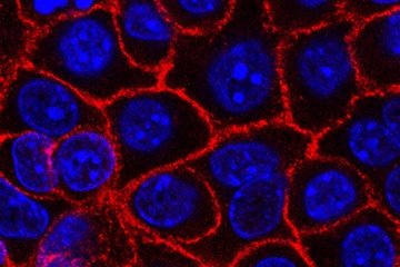 Células de câncer pancreático: doença de difícil tratamento ganha uma nova esperança - (crédito: Wikimedia Commons/Divulgação ) Células de câncer pancreático: doença de difícil tratamento ganha uma nova esperança - (crédito: Wikimedia Commons/Divulgação )