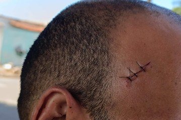 Ferimentos do vizinho que ajudou a conter a agressora -  (crédito: Fotos: Ana Carolina Alves/CB)