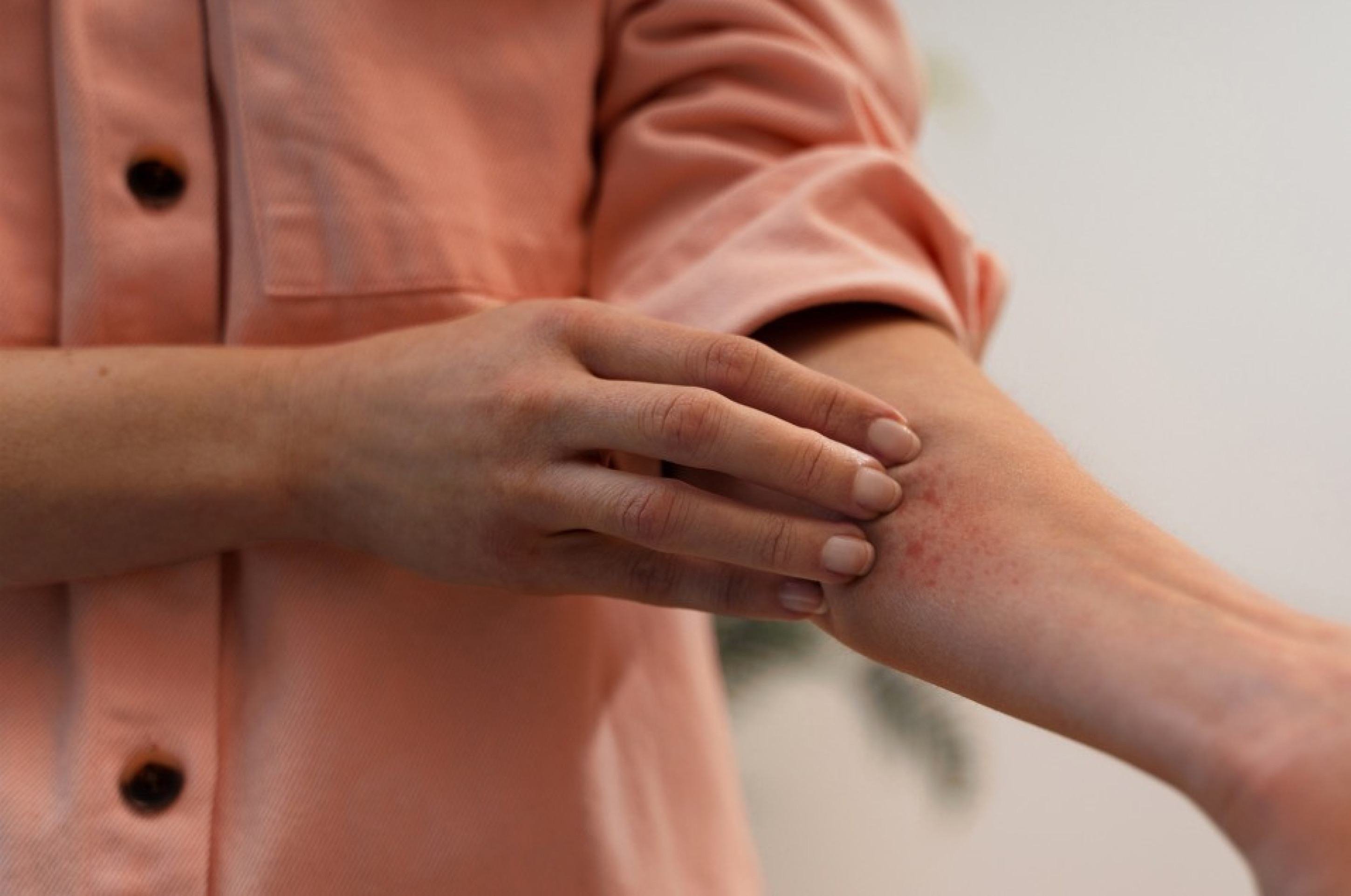 Dermatite atópica exige tratamento adequado para evitar evolução
