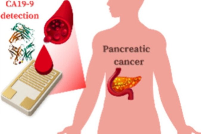  2026.Saúde. No artigo, os autores publicaram um esquema sintetizando o processo: uma gota de sangue do paciente é colocada no sensor, que detecta o CA 19-9, marcador do câncer de pâncreas