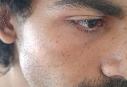 Estudante da UnB mostra rosto inchado após agressão dentro do supermercado Big Box da 408 Norte -  (crédito: Arquivo pessoal) -Estudante da UnB mostra rosto inchado após agressão dentro do supermercado Big Box da 408 Norte -  (crédito: Arquivo pessoal)