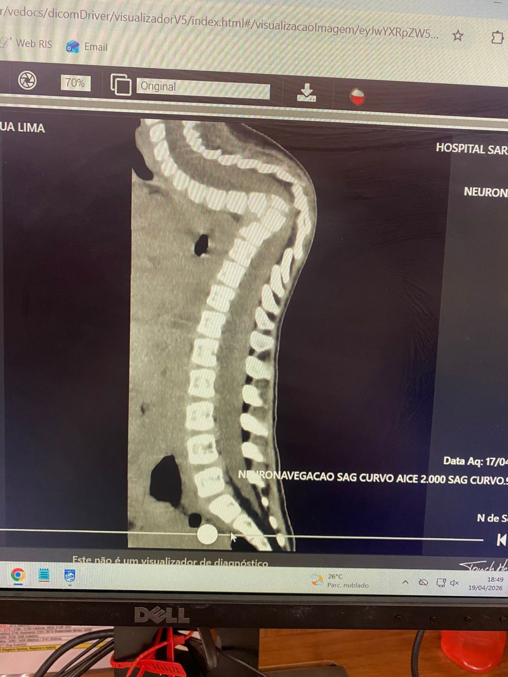 &Uacute;ltima tomografia feita: medula &oacute;ssea ainda mais comprimida 