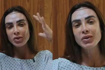 Nicole Bahls faz transplante capilar com técnica discreta e explica decisão - (crédito: Observatorio dos Famosos) Nicole Bahls faz transplante capilar com técnica discreta e explica decisão - (crédito: Observatorio dos Famosos)