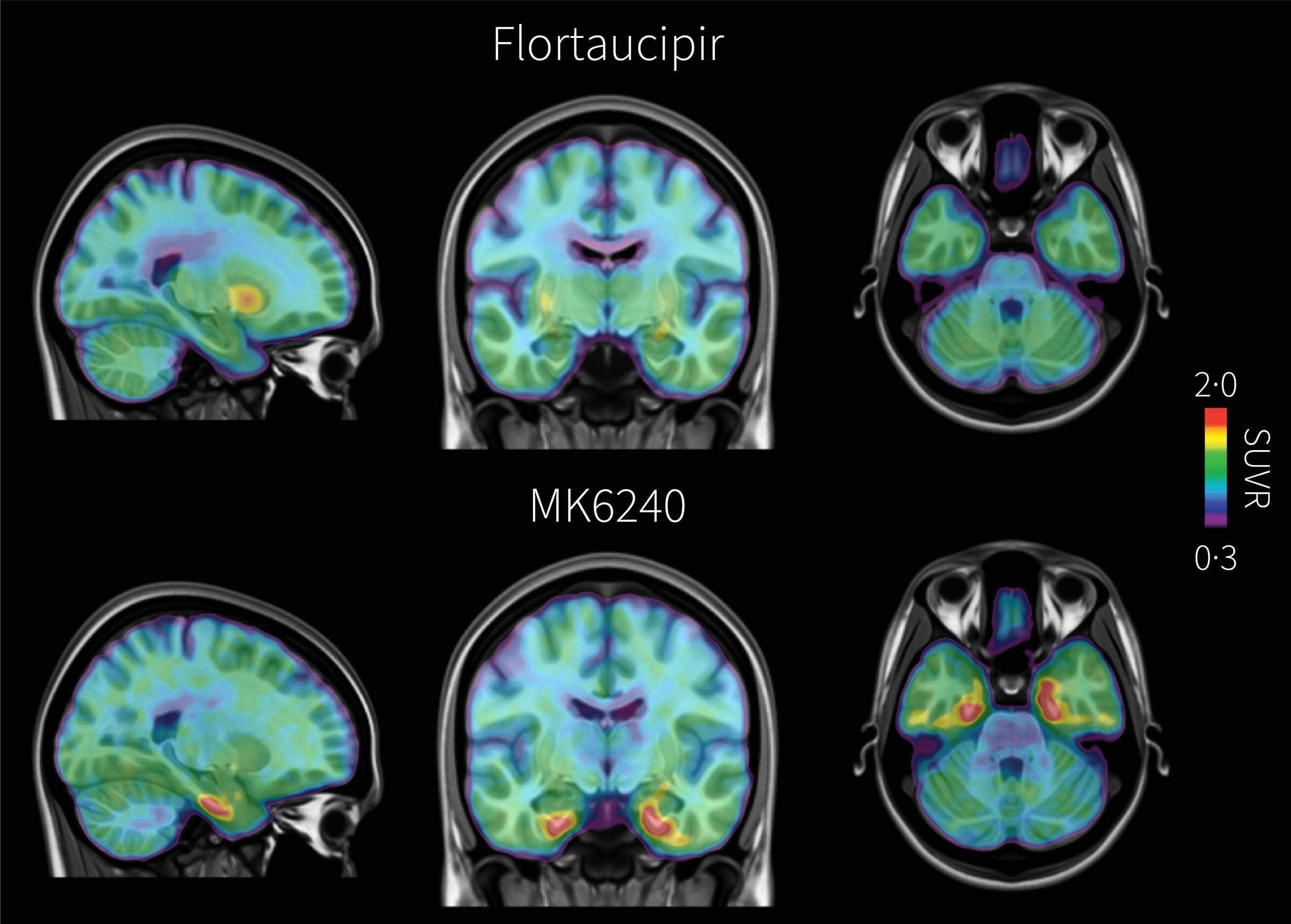Novo marcador para detectar Alzheimer em estágio inicial