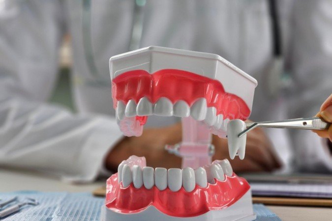 Presente em grande parte da população, o siso pode não encontrar espaço suficiente na arcada dentária e gerar complicações (Imagem: NMK-Studio | Shutterstock) - (crédito: EdiCase) Presente em grande parte da população, o siso pode não encontrar espaço suficiente na arcada dentária e gerar complicações (Imagem: NMK-Studio | Shutterstock) - (crédito: EdiCase)