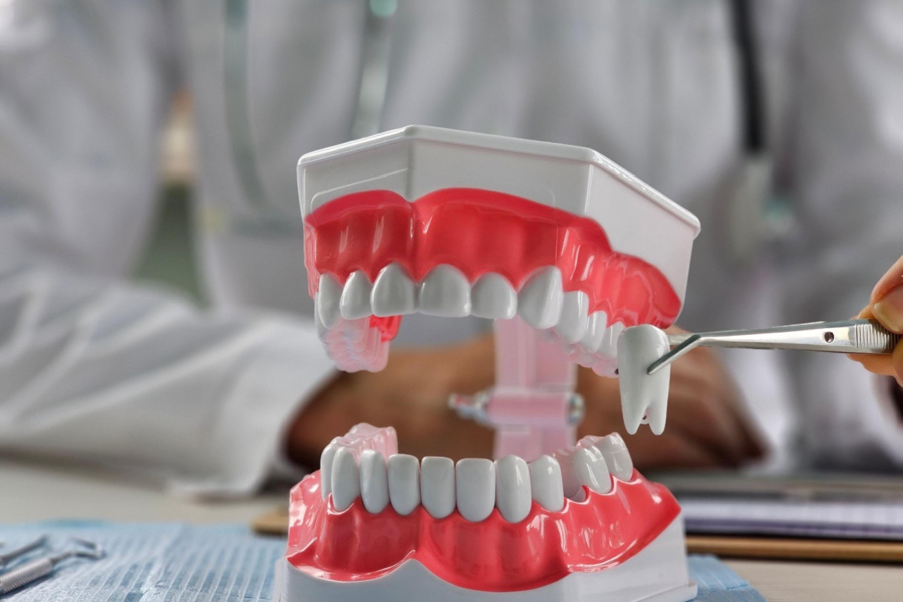 Dente do siso: entenda por que ele existe e quando a extração é necessária
