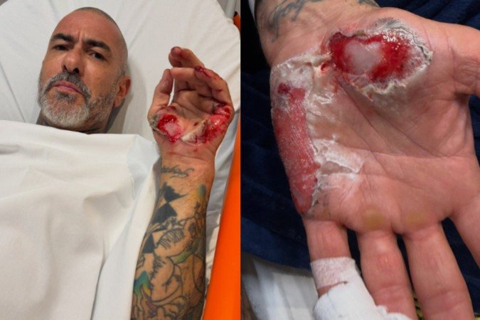 Causa do acidente que quase tirou a vida de Henrique Fogaça é revelado - (crédito: Reprodução/Instagram) Causa do acidente que quase tirou a vida de Henrique Fogaça é revelado - (crédito: Reprodução/Instagram)