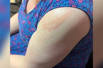 Marcas no corpo da mulher mostram as agressões - (crédito: Material cedido ao Correio) Marcas no corpo da mulher mostram as agressões - (crédito: Material cedido ao Correio)