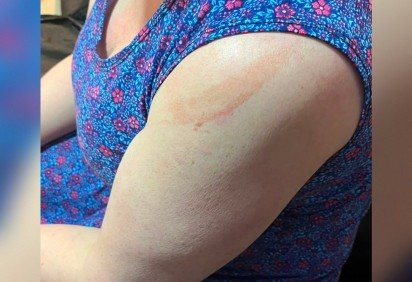 Marcas no corpo da mulher mostram as agressões -  (crédito: Material cedido ao Correio) -Marcas no corpo da mulher mostram as agressões -  (crédito: Material cedido ao Correio)