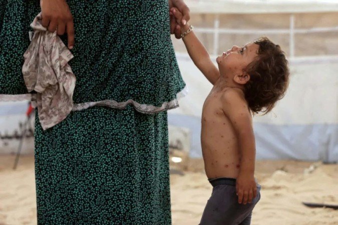 Catapora se espalha pelos superlotados acampamentos de deslocados em Gaza - (crédito: AFP) Catapora se espalha pelos superlotados acampamentos de deslocados em Gaza - (crédito: AFP)
