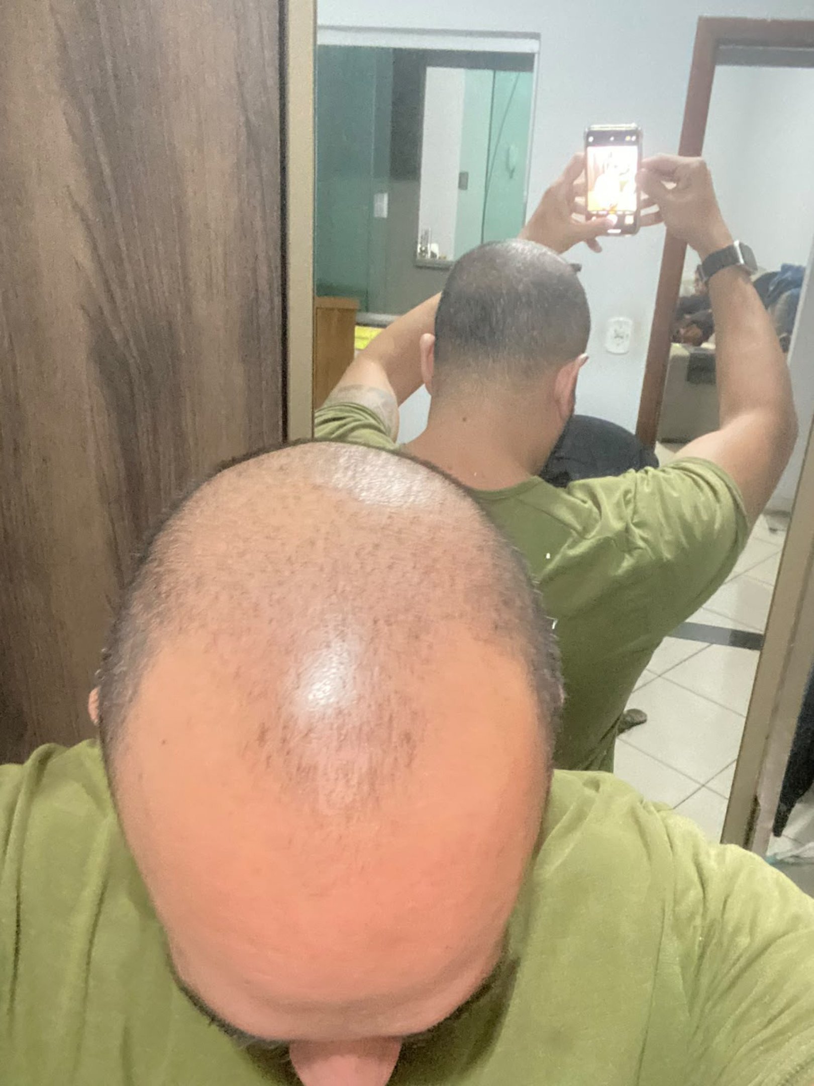 Igor Maia antes e depois  de realizar o procedimento