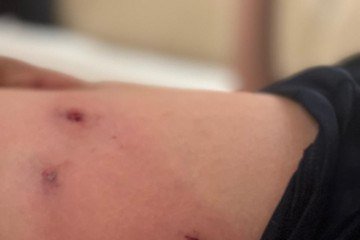 Criança sofreu vários ferimentos no corpo - (crédito: Material cedido ao Correio) Criança sofreu vários ferimentos no corpo - (crédito: Material cedido ao Correio)