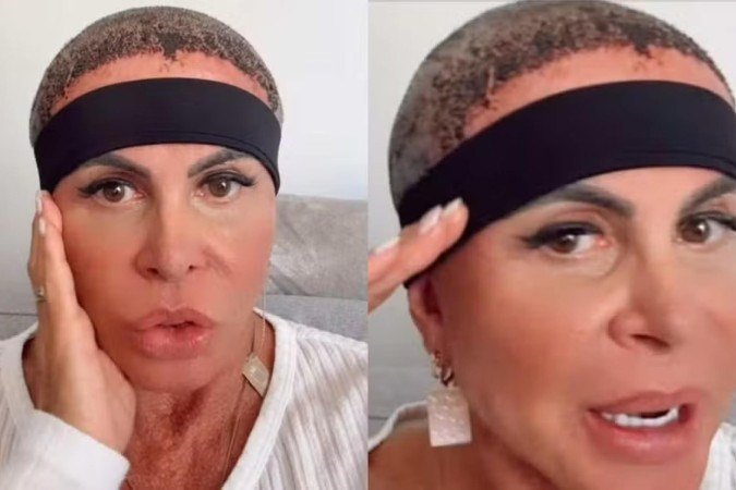 Gretchen mostra recuperação após transplante capilar: 'Estou bem'