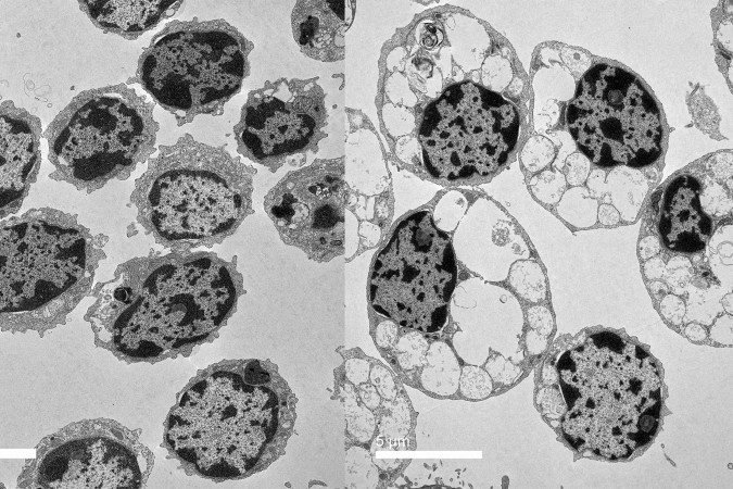 Cientistas identificaram a ligação da degeneração cerebral em adultos e a síndrome de Sanfilippo - (crédito: UC San Diego Health Sciences) Cientistas identificaram a ligação da degeneração cerebral em adultos e a síndrome de Sanfilippo - (crédito: UC San Diego Health Sciences)