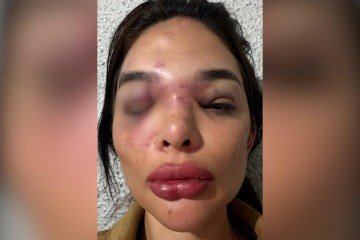 Vítima violência doméstica - (crédito: Reprodução/Redes Sociais) Vítima violência doméstica - (crédito: Reprodução/Redes Sociais)