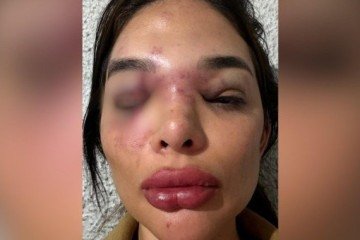 Giulia Falcão expõe rosto ferido após denunciar agressão pelo empresário Ivo Kos - (crédito: Arquivo pessoal) Giulia Falcão expõe rosto ferido após denunciar agressão pelo empresário Ivo Kos - (crédito: Arquivo pessoal)