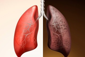 O contraste entre pulm&otilde;es saud&aacute;veis e doentes simboliza a urg&ecirc;ncia de diagn&oacute;sticos precoces no combate ao c&acirc;ncer de pulm&atilde;o -  (crédito: kchungtw)