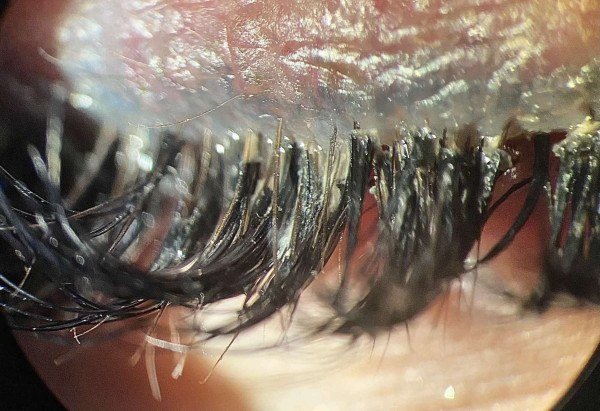 Tetiana Zhmud / ESCRS/Divulgação