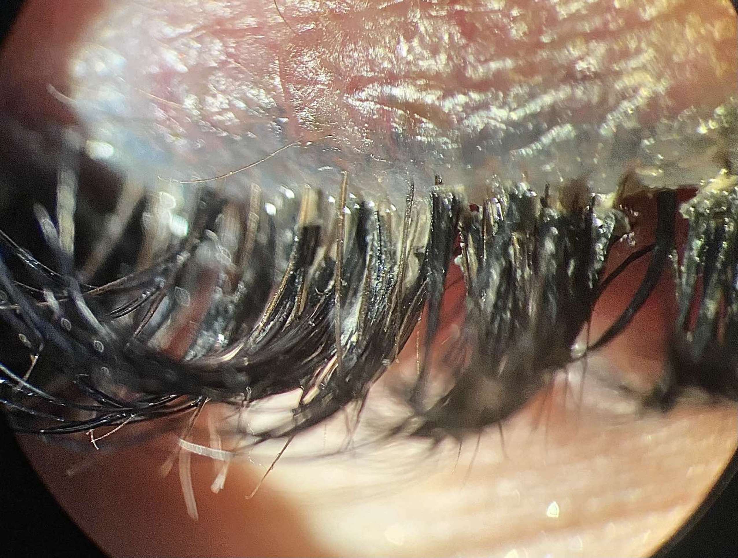 Extensão de cílios pode favorecer ácaros e causar problemas nos olhos
