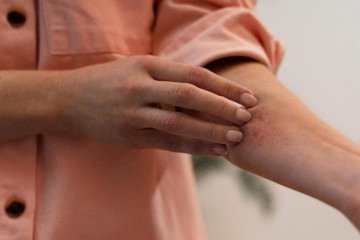 Lesões cutâneas como coceira e eczemas podem indicar inflamação tipo 2, uma resposta imunológica desregulada que afeta a pele - (crédito: Freepik) Lesões cutâneas como coceira e eczemas podem indicar inflamação tipo 2, uma resposta imunológica desregulada que afeta a pele - (crédito: Freepik)