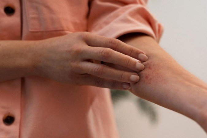 Lesões cutâneas como coceira e eczemas podem indicar inflamação tipo 2, uma resposta imunológica desregulada que afeta a pele - (crédito: Freepik) Lesões cutâneas como coceira e eczemas podem indicar inflamação tipo 2, uma resposta imunológica desregulada que afeta a pele - (crédito: Freepik)