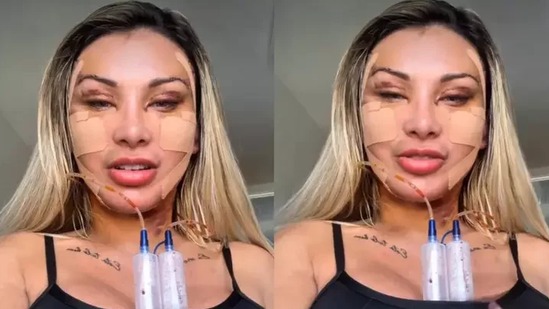 Arrependimento e sequelas de interven&ccedil;&otilde;es est&eacute;ticas faciais refor&ccedil;am o alerta de celebridades como Andressa Urach sobre os riscos -  (crédito: reprodu&ccedil;&atilde;o/Instagram)