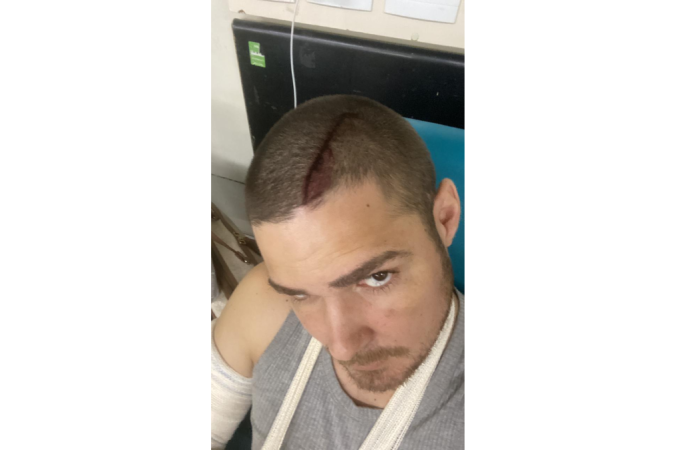 Lucas Fonseca Ribeiro, 29, mostra machucado de garrafada de vidro feito por namorado após briga na Asa Norte - (crédito: Arquivo pessoal) Lucas Fonseca Ribeiro, 29, mostra machucado de garrafada de vidro feito por namorado após briga na Asa Norte - (crédito: Arquivo pessoal)