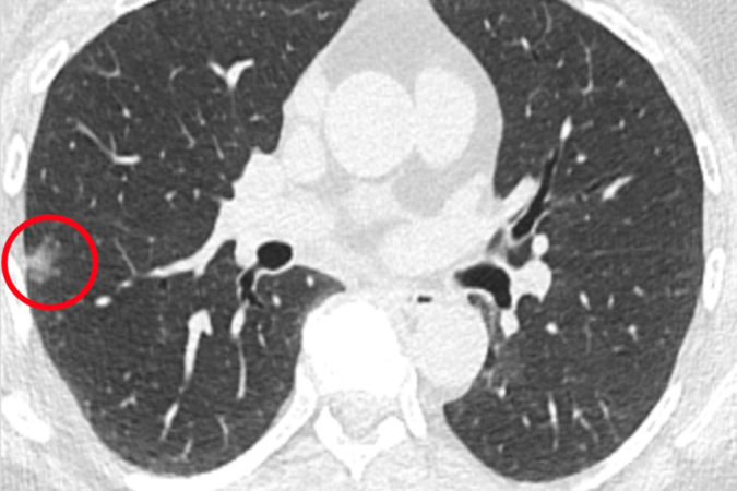 Ajuda ao Tratamento Cancer Pumao Sarcoma