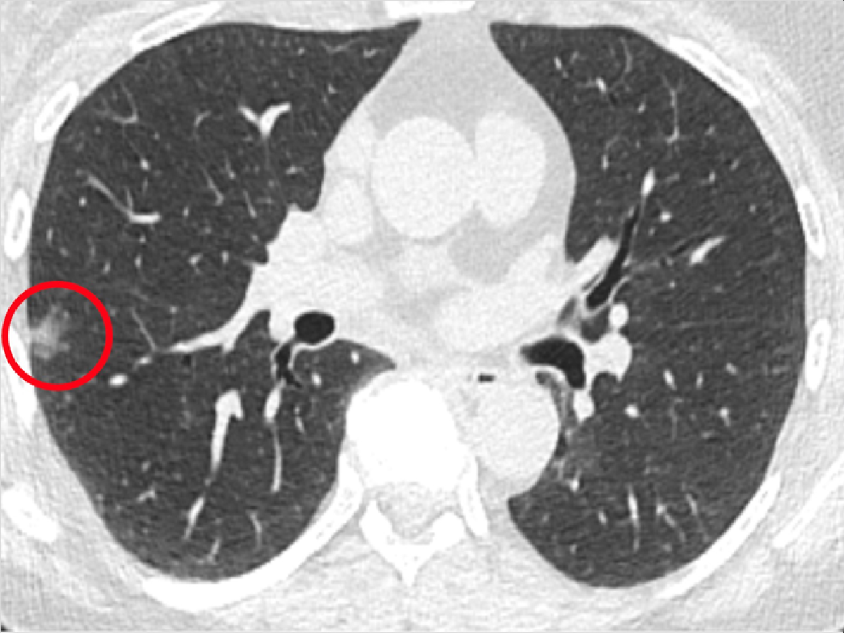 Varredura de um paciente no estudo liderado pela Penn Medicine com um nódulo pulmonar, circulado em vermelho