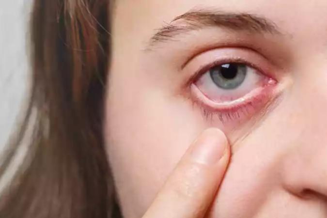 Verstehe, wie sich Augenherpes manifestiert
