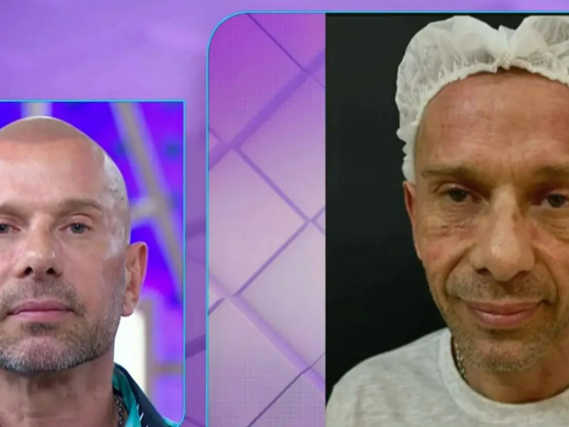 Antes e depois da harmonização facial feita por Rafael Ilha