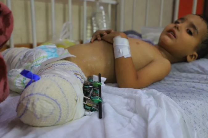 Ahmed Shabat, de 3 anos, perdeu as pernas em uma explosão em Gaza. - (crédito: MAHMOUD AKI) Ahmed Shabat, de 3 anos, perdeu as pernas em uma explosão em Gaza. - (crédito: MAHMOUD AKI)