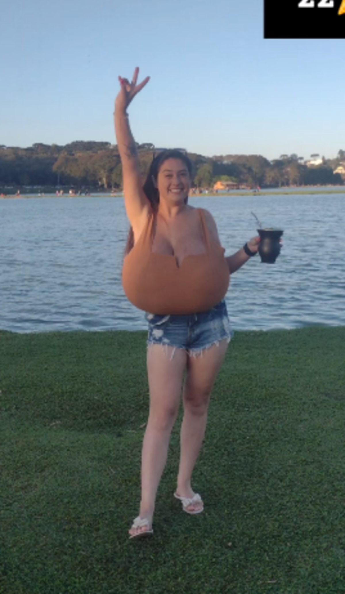 A jovem com gigantomastia que retirou 10 kg das mamas