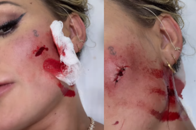 Andressa Urach sai ferida de festa  -  (crédito: Reprodução Instagram )