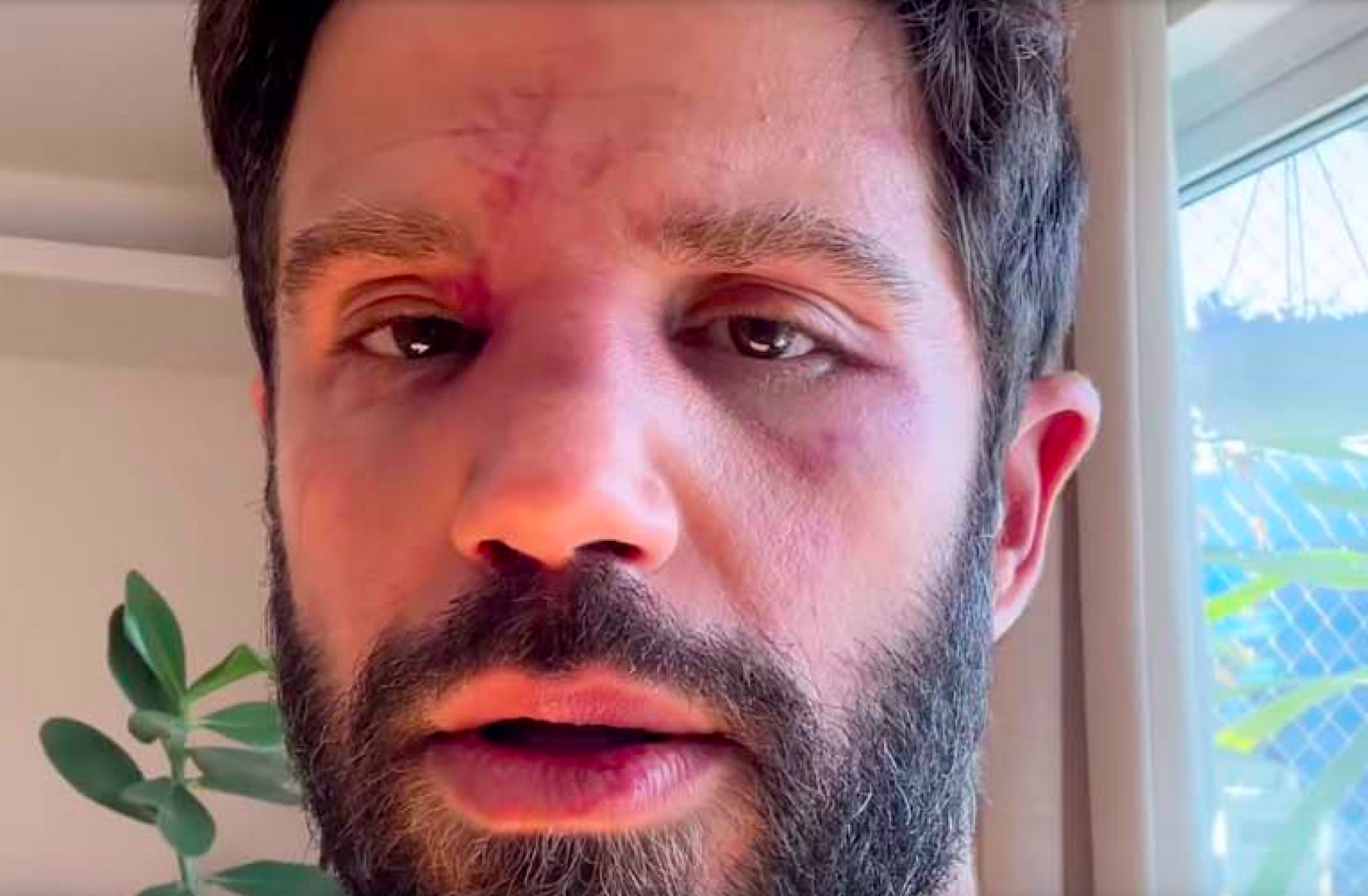 Duda Nagle mostra hematomas após luta com Popó: 