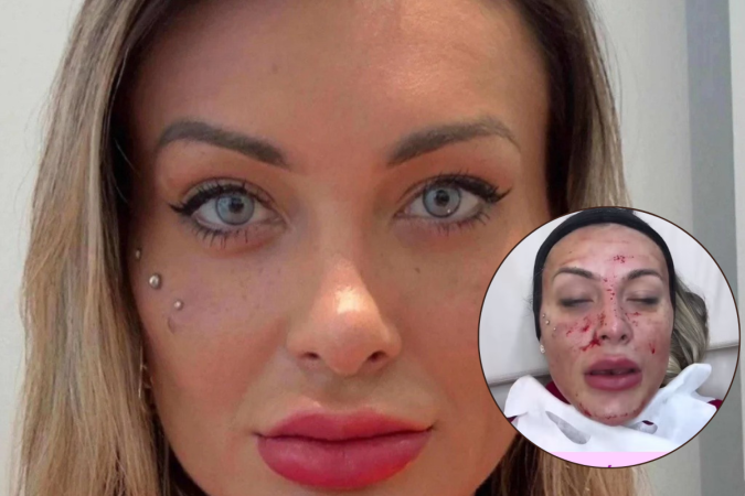 Andressa Urach surge com rosto sangrando após procedimento  -  (crédito: Redes Sociais)