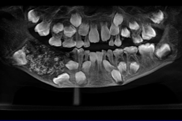O garoto apresentava uma pequena protuberância na mandíbula. A característica passou despercebida durante quatro anos - (crédito: Saveetha Dental College and Hospital) O garoto apresentava uma pequena protuberância na mandíbula. A característica passou despercebida durante quatro anos - (crédito: Saveetha Dental College and Hospital)