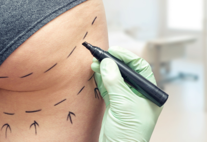 Sasha Dean entrou em coma depois de um BBL -  (crédito: BBC) -Sasha Dean entrou em coma depois de um BBL -  (crédito: BBC)