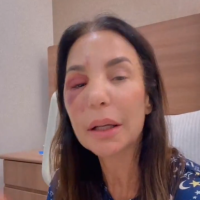 Ivete disse que está bem se recuperando -  (crédito: Reprodução / Instagram / @ivetesangalo)