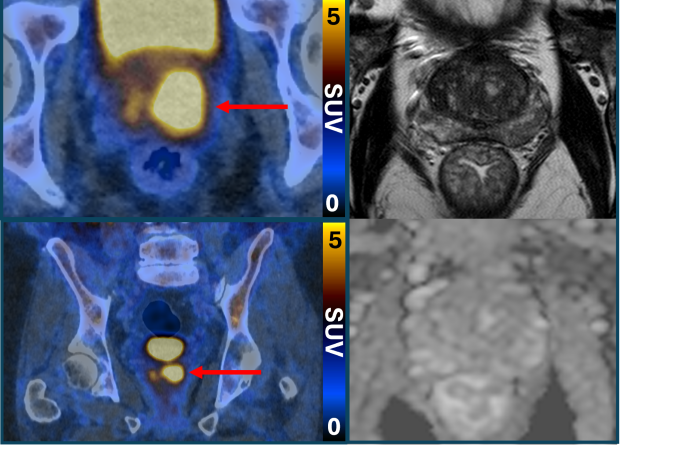 Câncer de próstata clinicamente significativo (esquerda, PET/CT com PSMA) apesar da ressonância magnética normal (direita)

