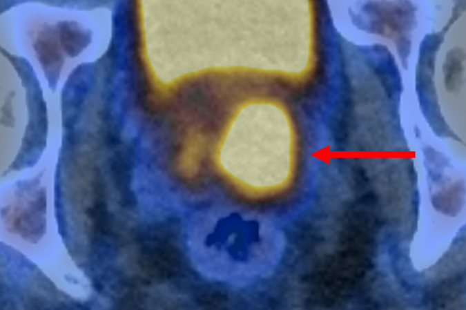 Imagem PET/CT com PSMA mostrando células cancerígenas da próstata brilhantes.

