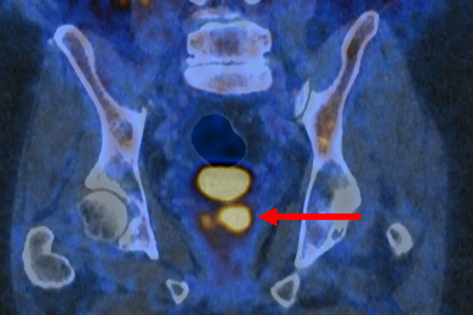 Imagem PET/CT com PSMA mostrando células cancerígenas da próstata brilhantes.

