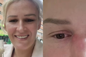Tumor agressivo escondido em um pequeno caroço no nariz mudou a vida de Mel Frisby - (crédito: Reprodução/TikTok @melfrisbyofficial) Tumor agressivo escondido em um pequeno caroço no nariz mudou a vida de Mel Frisby - (crédito: Reprodução/TikTok @melfrisbyofficial)